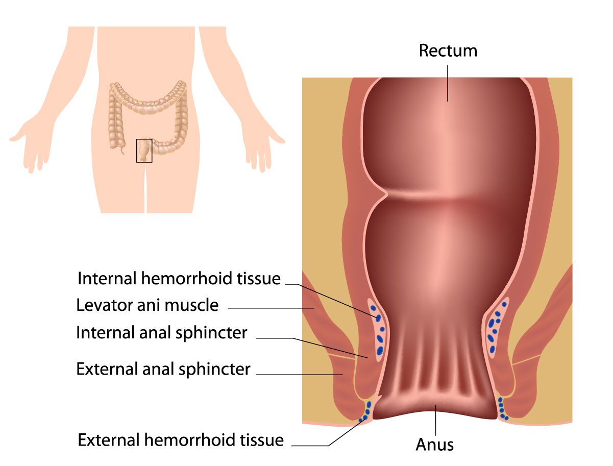 Treatment for external and internal Bleeding hemorrhoids