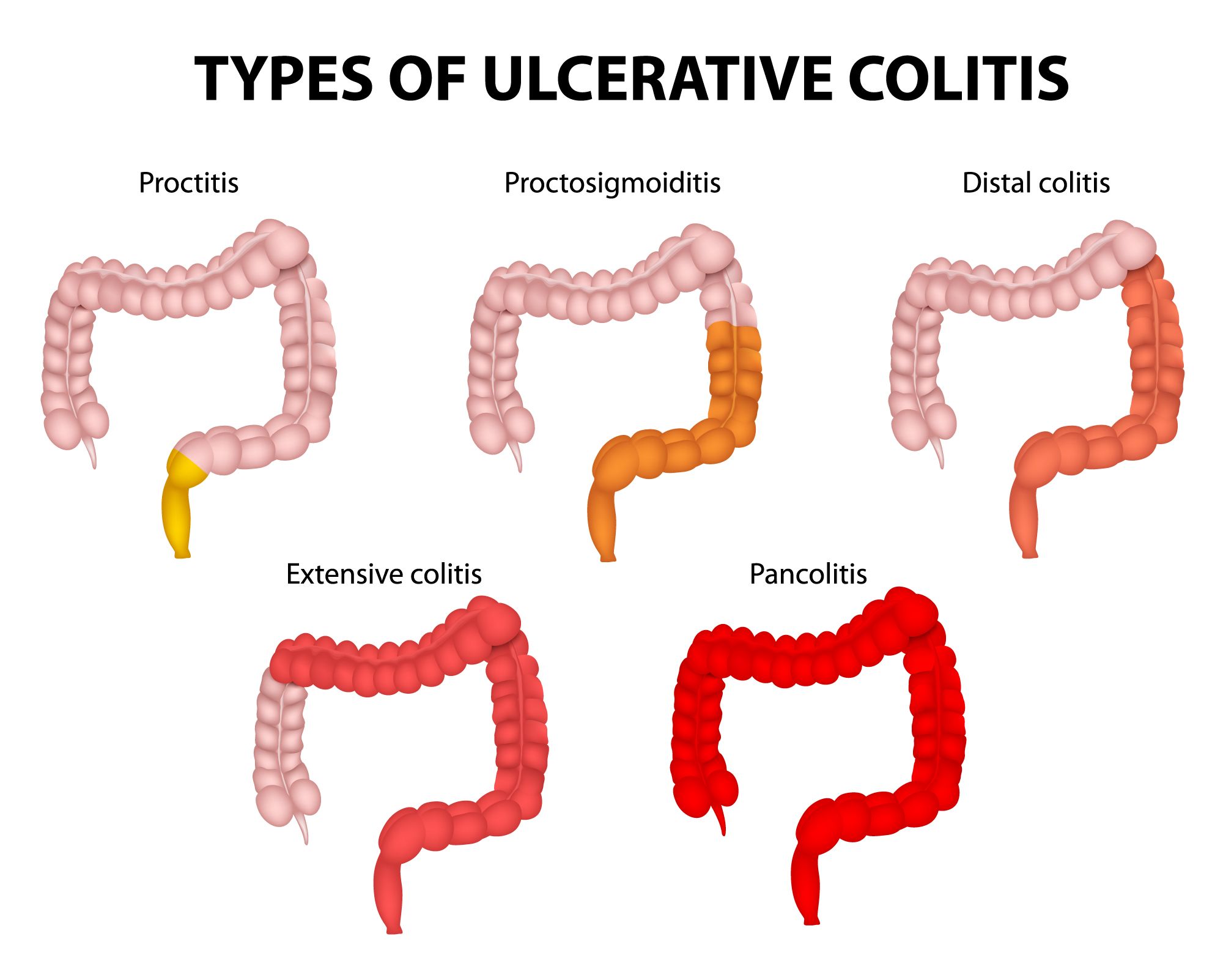 presentation of ulcerative colitis