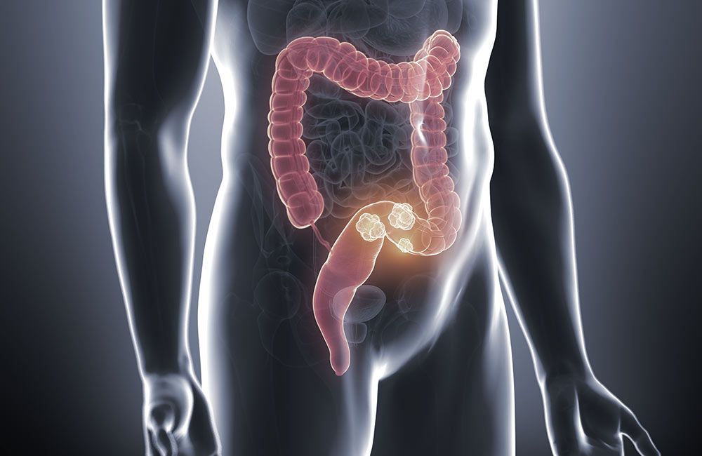 Illustration of retrorectal tumor