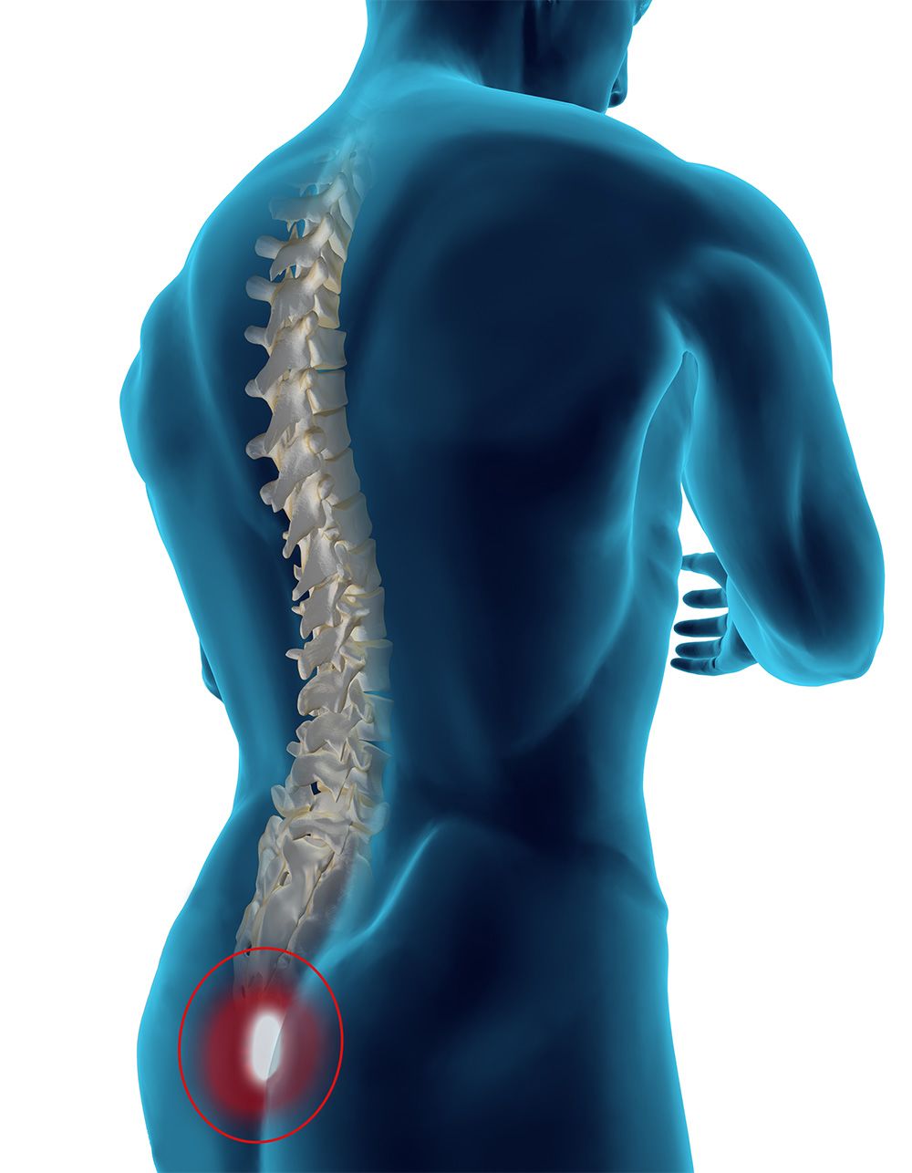 Pilonidal Sinus: Pictures, What is it, Causes, Symptoms