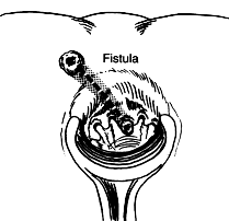 Anal abscess treatment diagram.